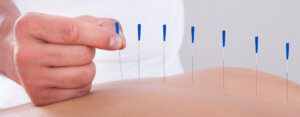 How Does Physical Therapy Dry Needling With Electrical Stimulation Improve  Symptoms? - Mend Colorado