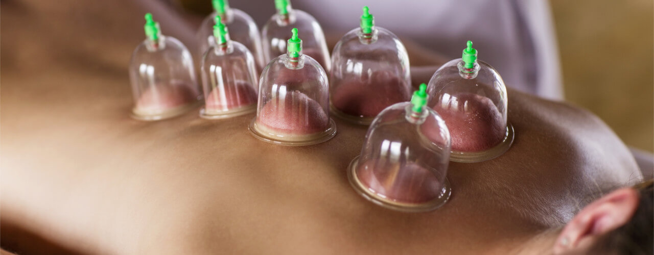 Cupping Therapy Windsor, Loveland, Fort Collins, Greeley, Johnstown, Thornton, and Broomfield, Colorado